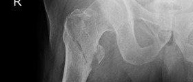 Osteoporosis And Broken Bones: What Can You Expect From Hip Fractures?